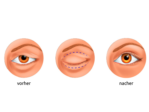 Lidoperation und Behandlung von Schlupflidern