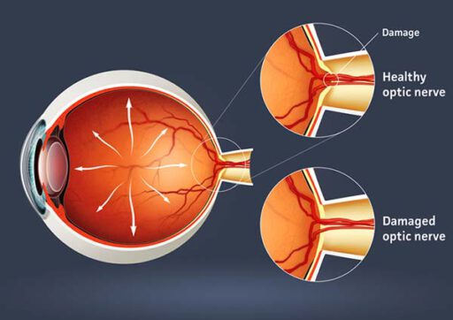 AOZ Neuss für Grüner Star bzw. Glaucombehandlung in Neuss