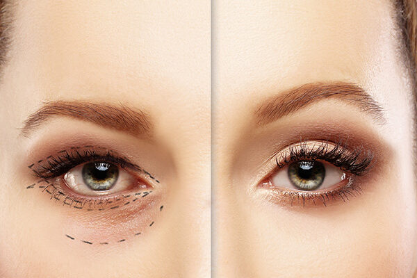 Schlupflider und Faltenbehandlungen bei den Experten im Augenzentrum