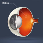 Netzhautbehandlung in Neuss am Hasenberg _ MVZ Augenärzte